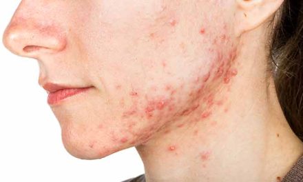 Cara Mengobati Cystic Acne Secara Bertahap Dan Juga Rutin