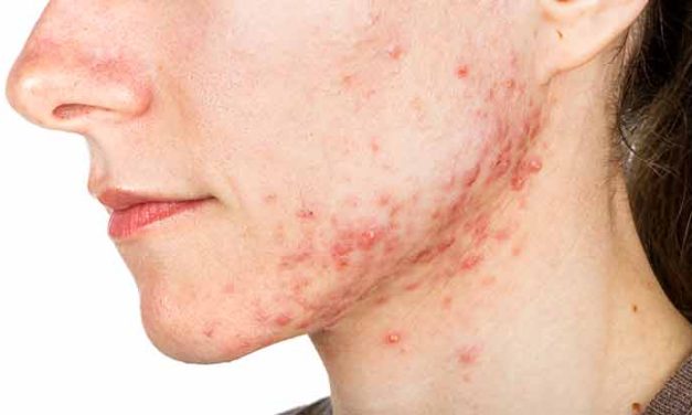 Cara Mengobati Cystic Acne Secara Bertahap Dan Juga Rutin
